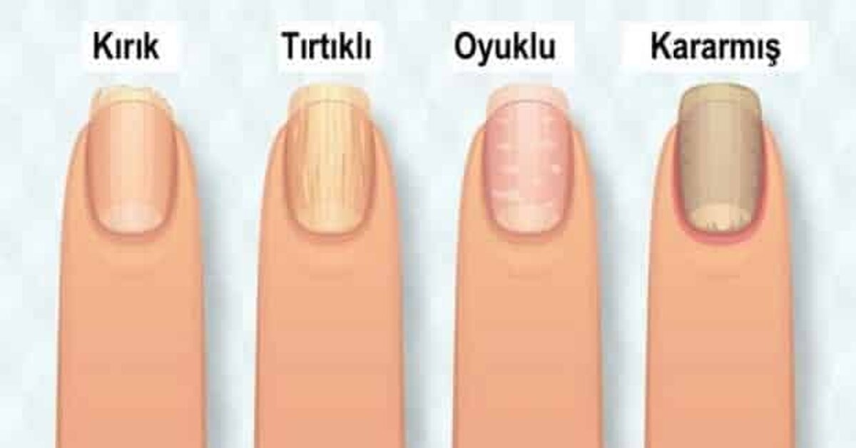 Tırnaklar Sağlığınız Hakkında Ne Diyor?