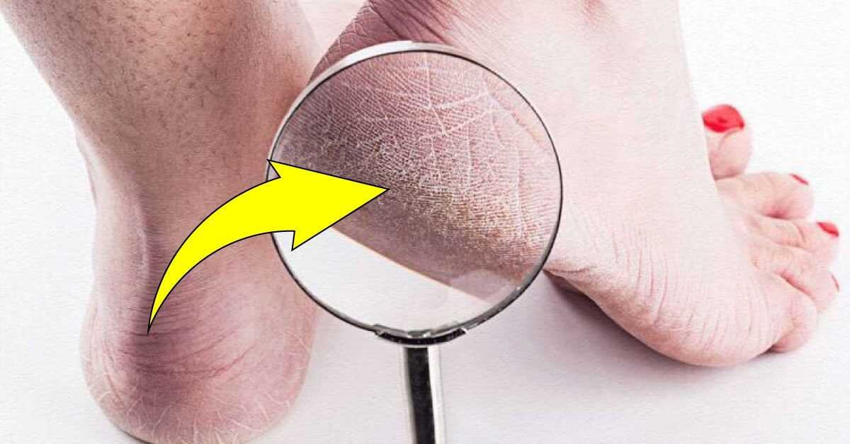 Topuk Çatlaklarına 1 Gecede Elveda