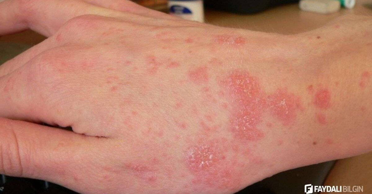 Uyuz Tedavisi hakkında sıkça sorulan sorular