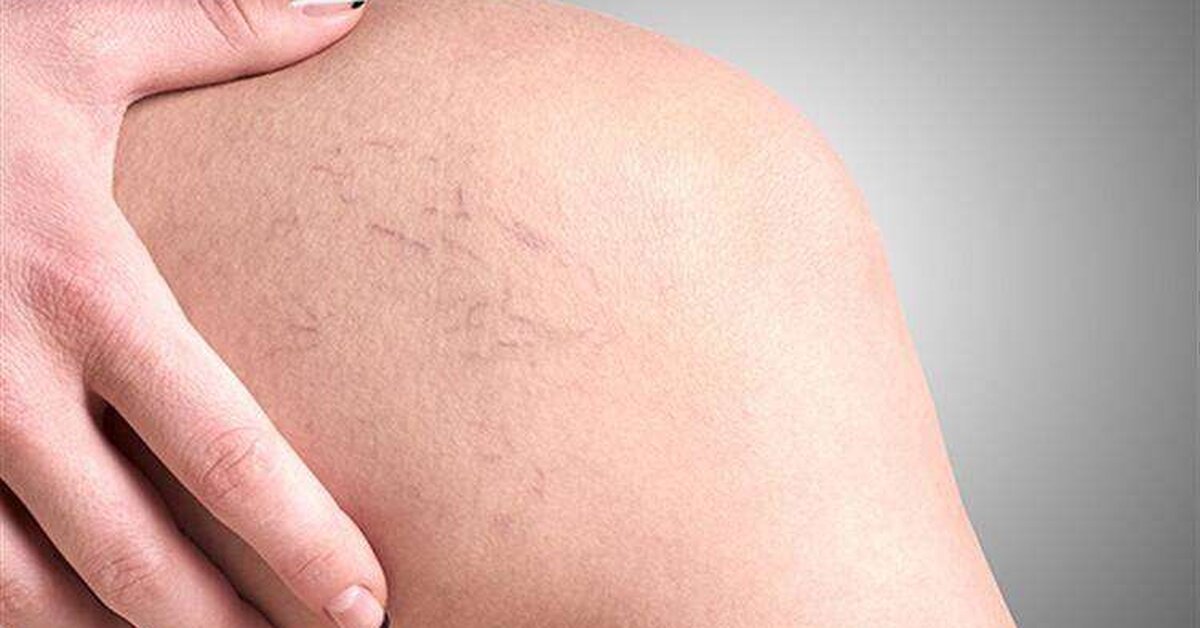 Varis Tedavisi İçin Bitkisel Kür