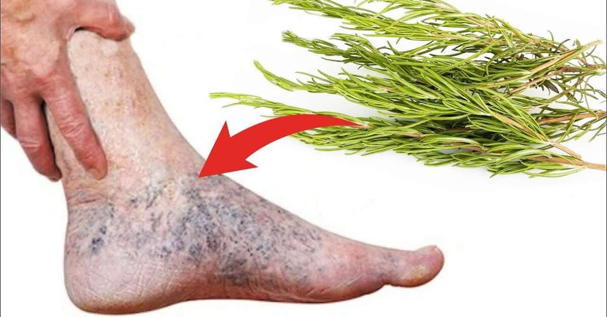 Varise Doğal Çözümler Nelerdir? Bitkisel Yöntemler