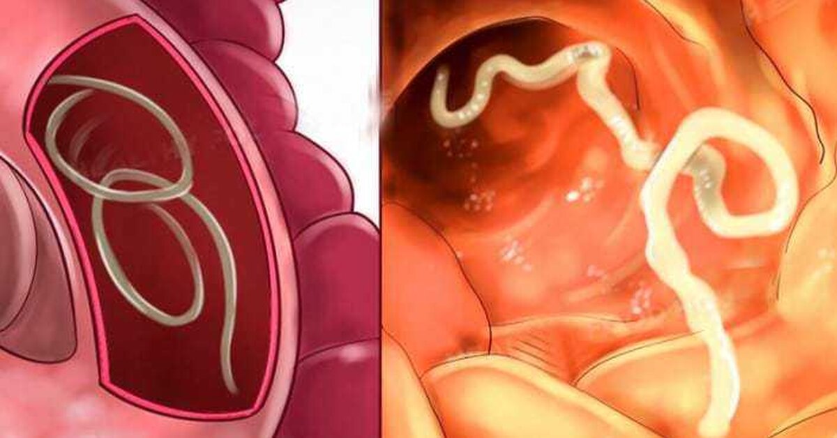 Vücuttaki Parazitler İçin Bitkisel Çözümler