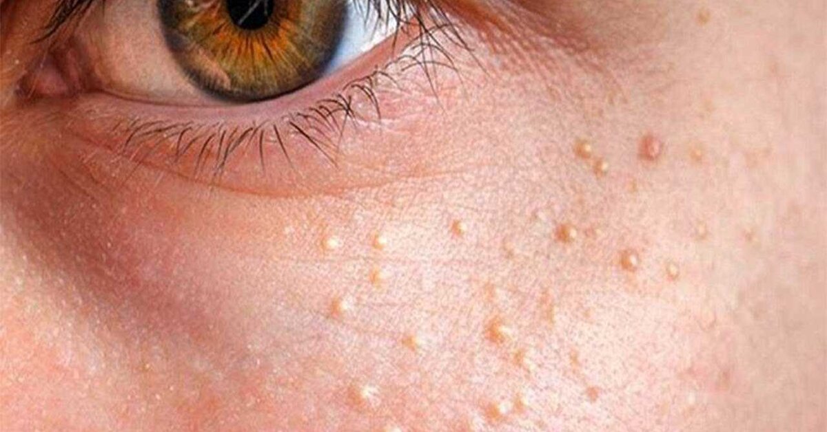 İbrahim Saraçoğlu’ndan Yağ Bezeleri İçin Öneriler