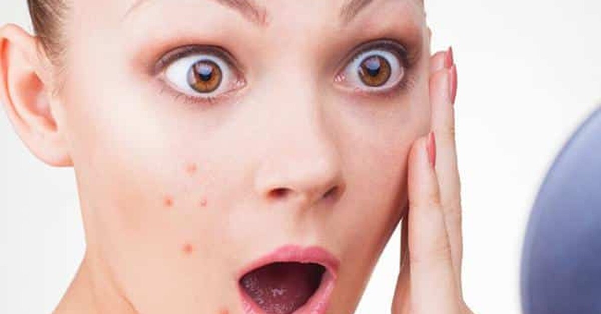 Yüzde Çıkan Sivilcelere Doğal Çözümler