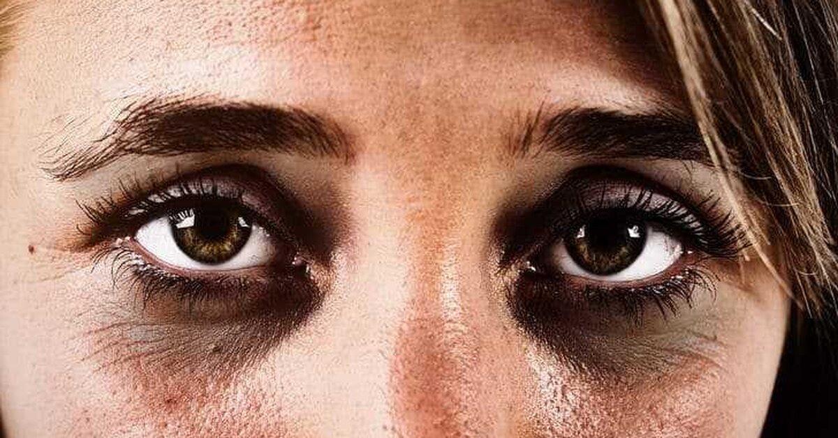 Yüzdeki Morluklar Nasıl Kapatılır?