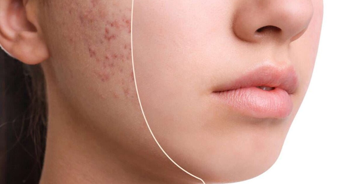 Yüzdeki Yara İzleri Nasıl Geçer?