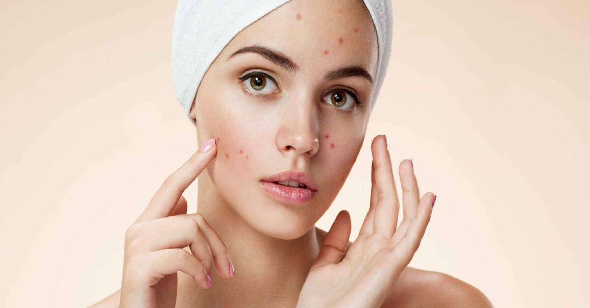 Yüzünüzdeki aknelerin bir anlamı var!