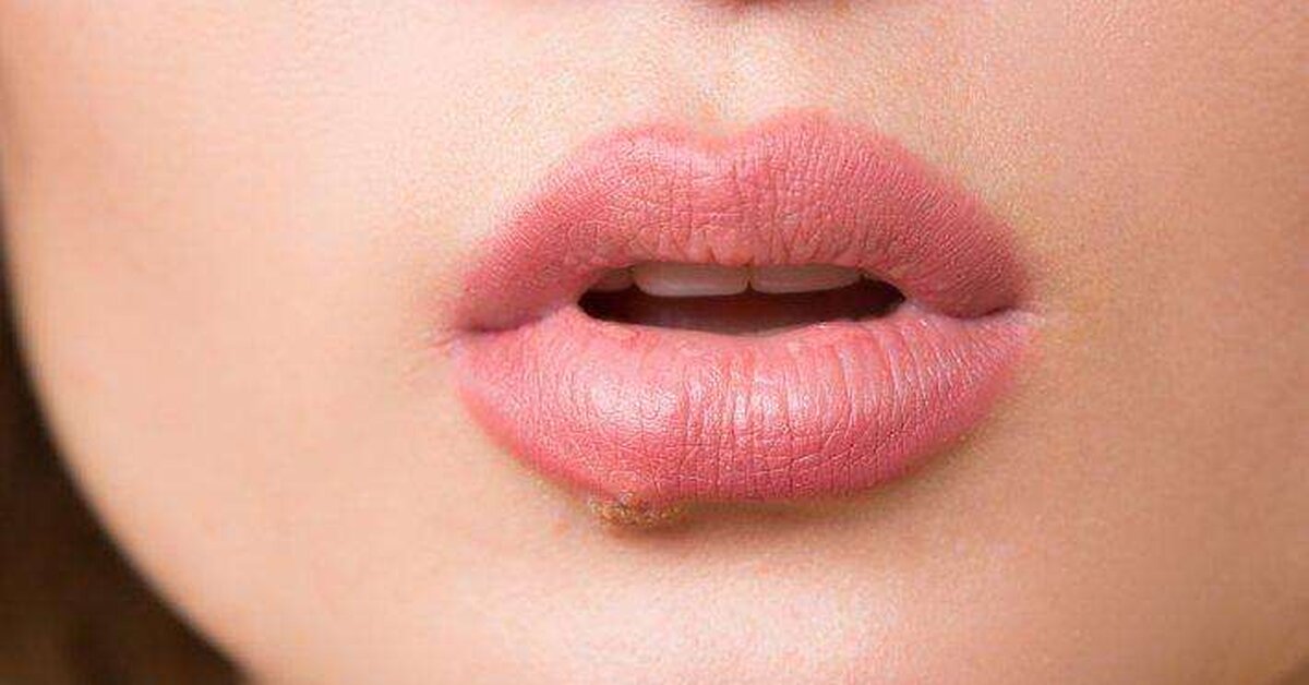 1 Günde Uçuk Hemen Nasıl Geçer?