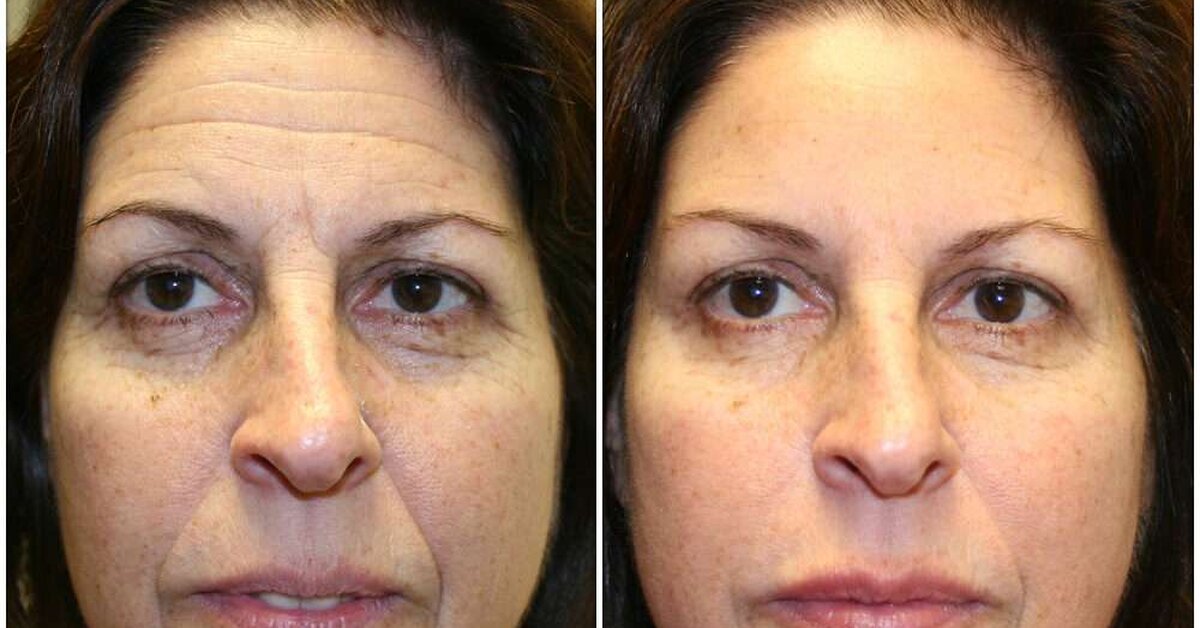 15 Dakikada Leke Giderici Sıkılaştırıcı Kırışık Açıcı Doğal Maske Tarifi