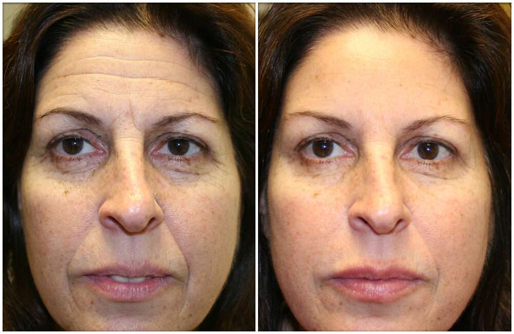 15 Dakikada Leke Giderici Sıkılaştırıcı Kırışık Açıcı Doğal Maske Tarifi