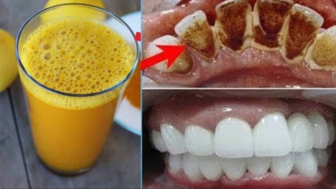 2 Dakika İçinde Sarı Dişlere Ev Yapımı Doğal Çözüm