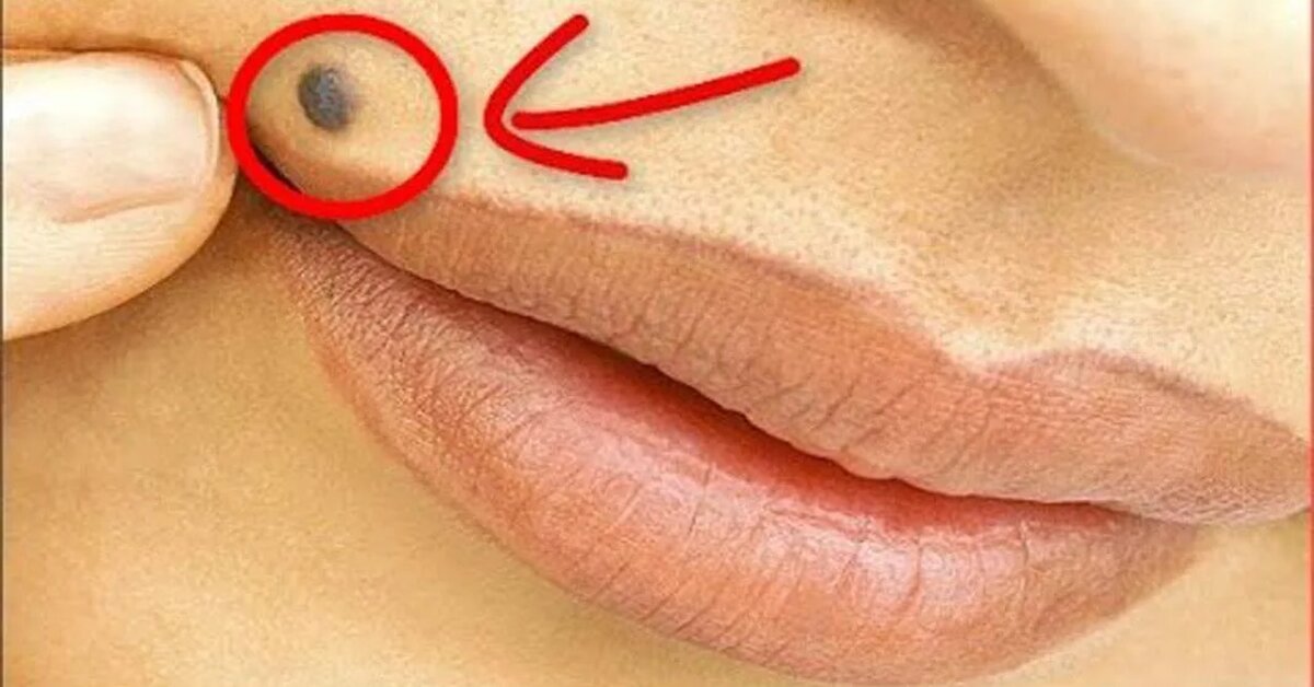 Vücudunuzun Bu 7 Noktasında Ben Varsa Dikkat!