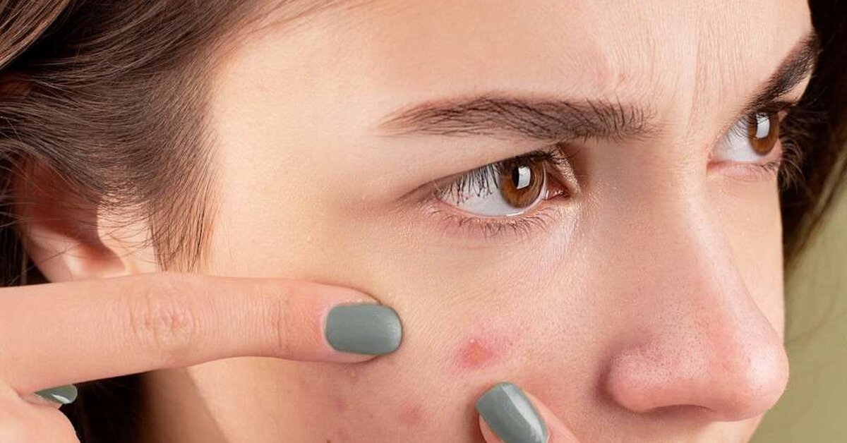 Doğal Ürünlerle Sivilce Tedavisi Nasıl Yapılır?