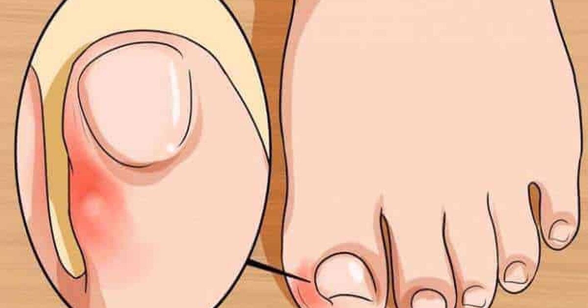 Ayaklarınızdaki Tırnak Batmasını Evde Tedavi Etmek İçin 5 Çözüm