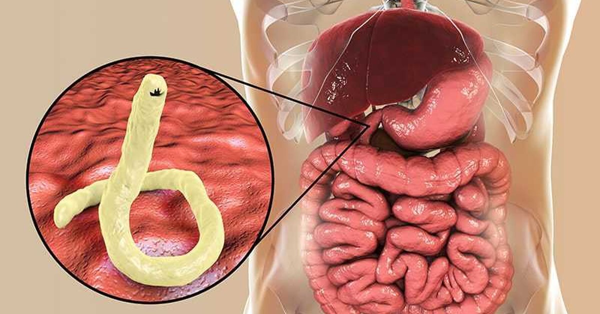 Vücuttaki Bağırsak Kurtlarını Döken En Etkili Doğal Çözüm!