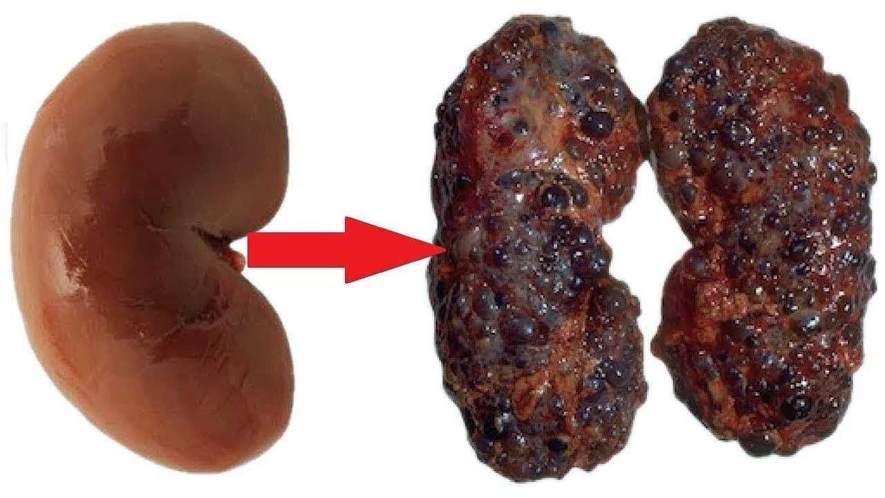 Böbreklere Zarar Veren Alışkanlıklar