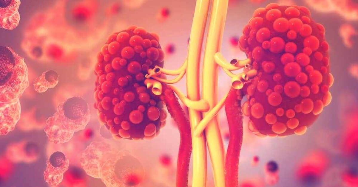 Böbrekte Üre ve Kreatinin Yüksekliği Nedenleri ve Tedavisi