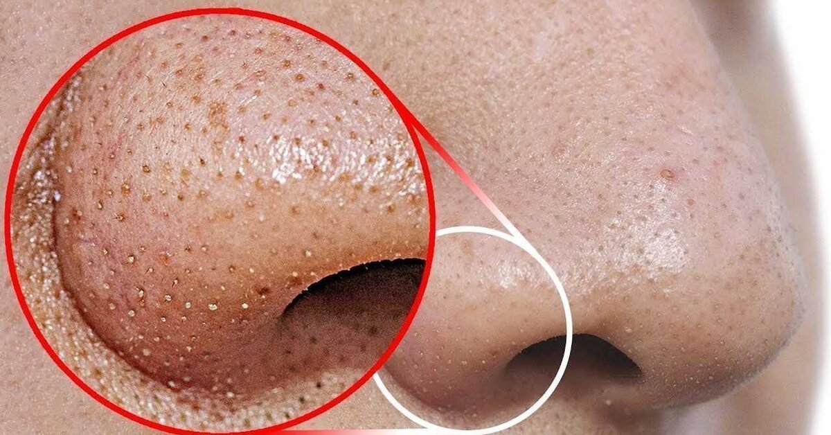 Burundaki Siyah Noktalar İçin Doğal Tedaviler Nelerdir?