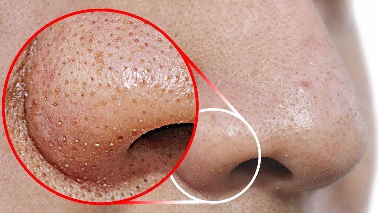 Burundaki Siyah Noktalar İçin Doğal Tedaviler Nelerdir?