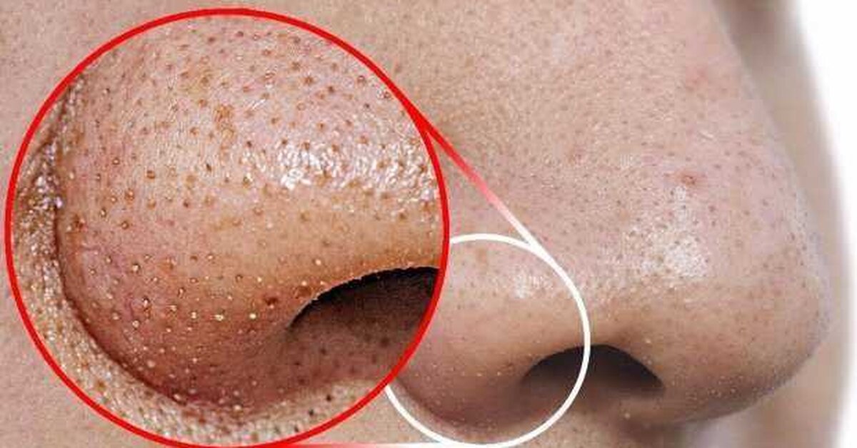 Burundaki Siyah Noktalara ve Sivilcelere Kesin Çözüm!