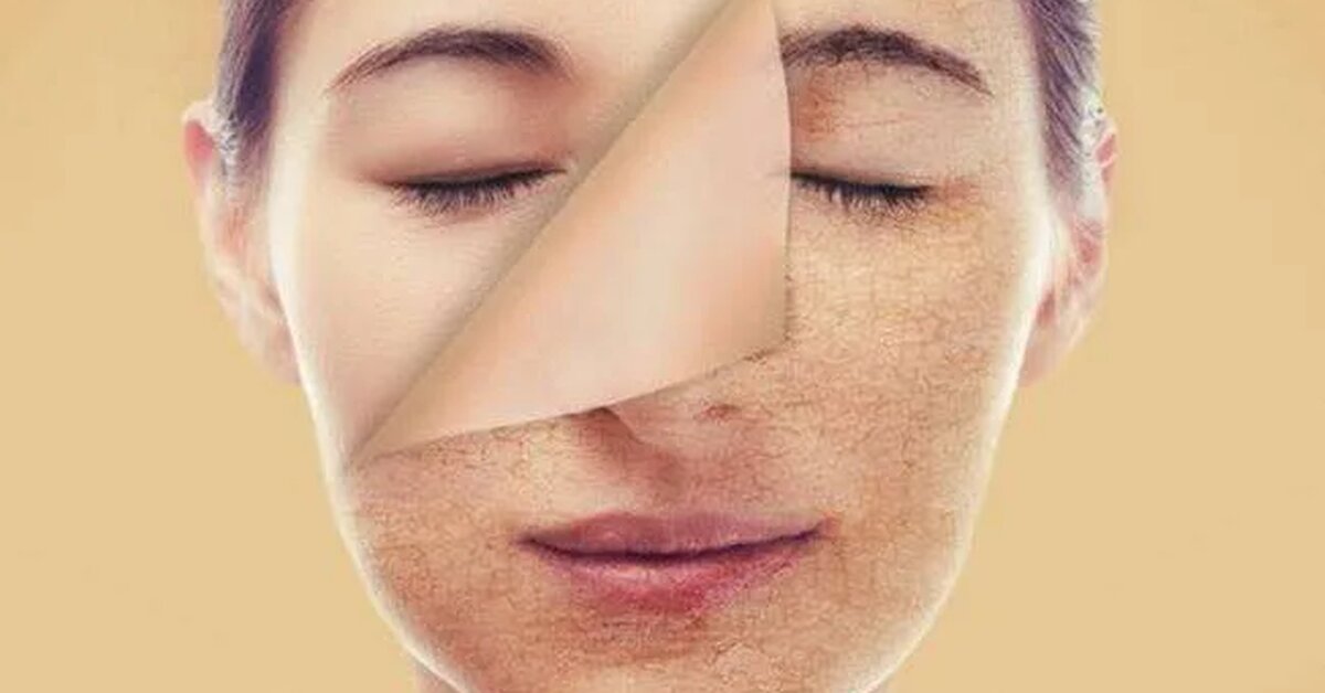 Cilt Kuruluğuna Neler İyi Gelir?