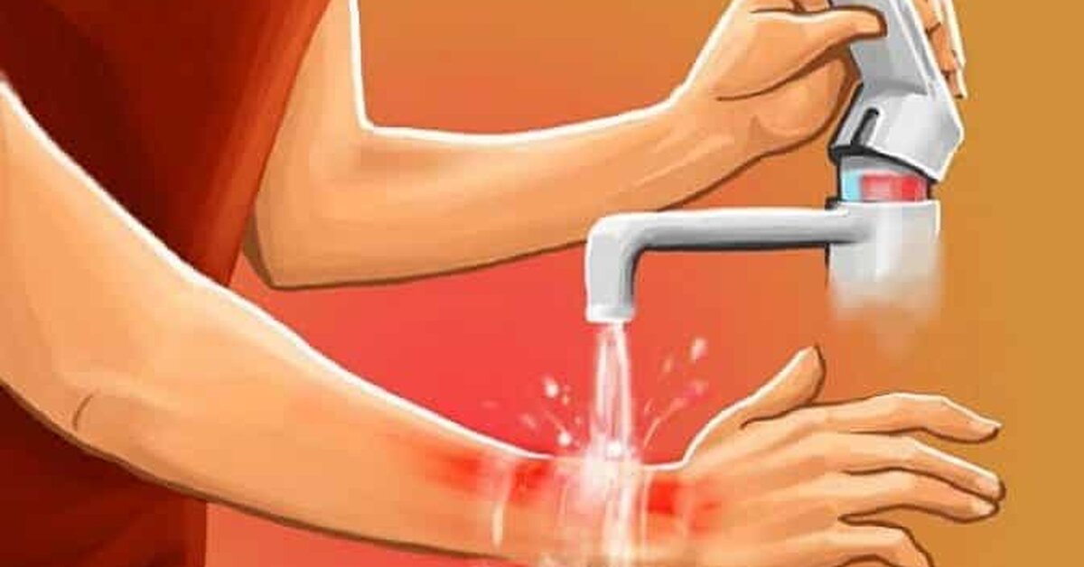 Cilt Yanığına Ne İyi Gelir?