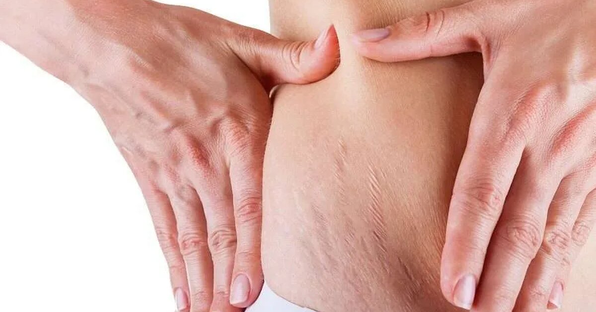 Ciltte Oluşan Çatlamalara Neler İyi Gelir?