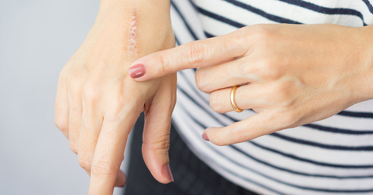 Ciltte Oluşan Yaralar Nasıl Geçer?