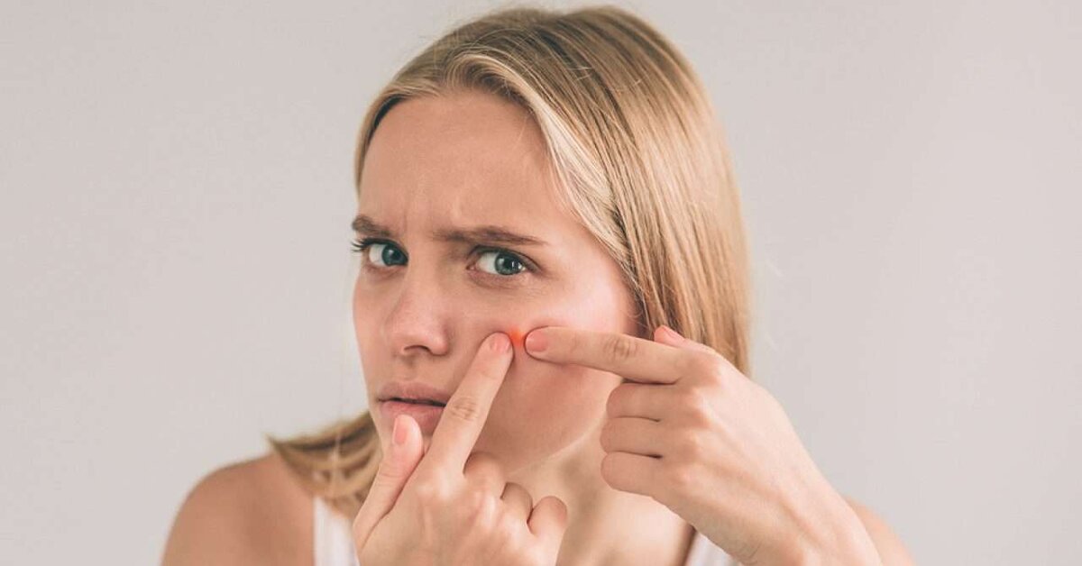 Doğal Ürünlerle Sivilce Tedavisi