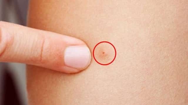Doktorlar Uyardı! Sivrisinek Isırığından Sonra Mutlaka Bunu Yapın!