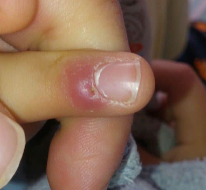 Dolama nedir? Dolama Nasıl Tedavi Edilir? Kesin Çözüm!