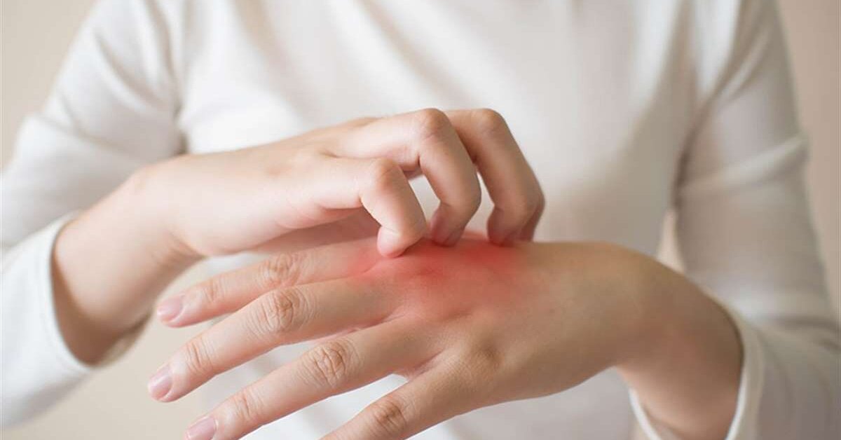 Eczaneden aldığı kremle egzamadan kurtuldu!