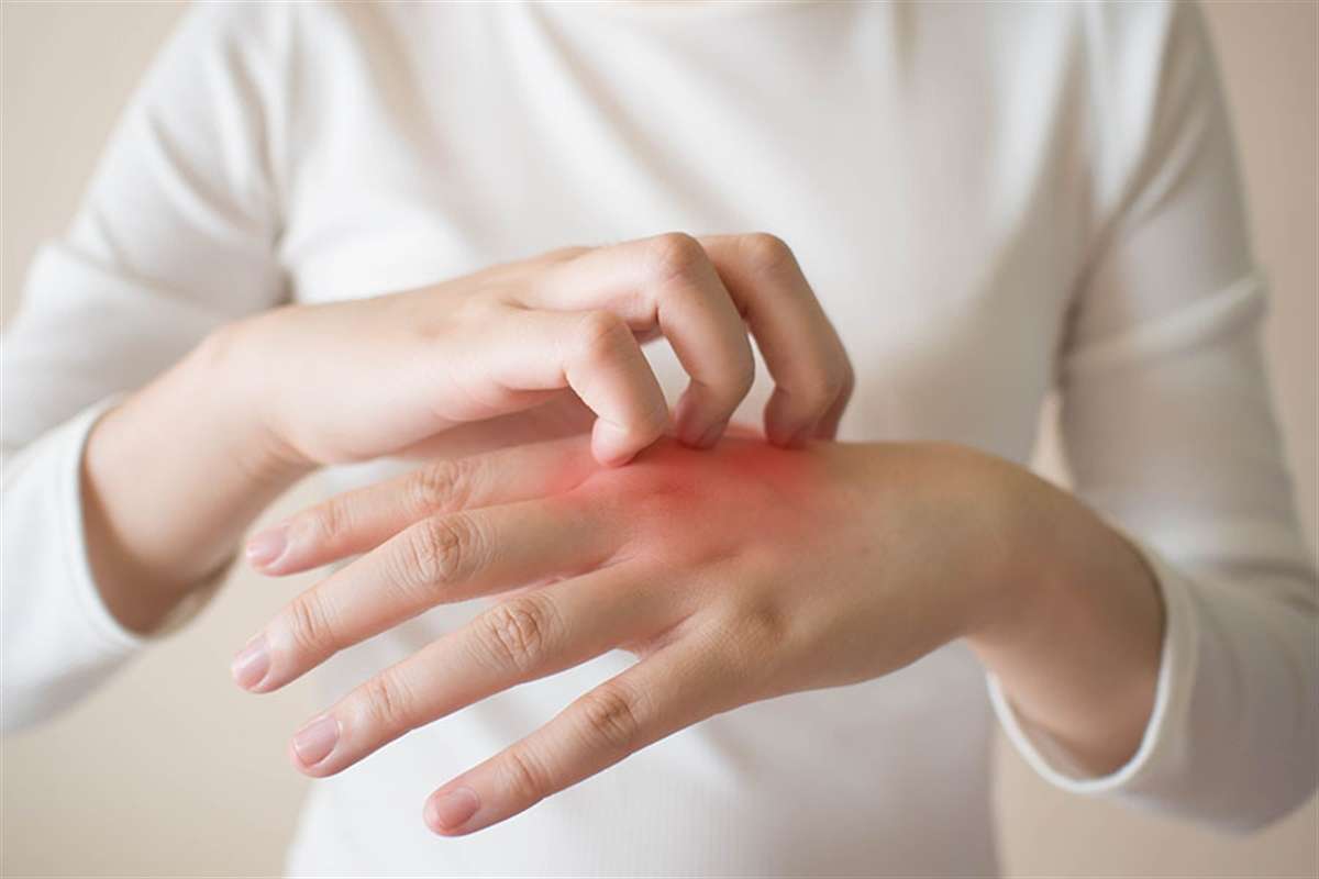 Eczaneden aldığı kremle egzamadan kurtuldu!