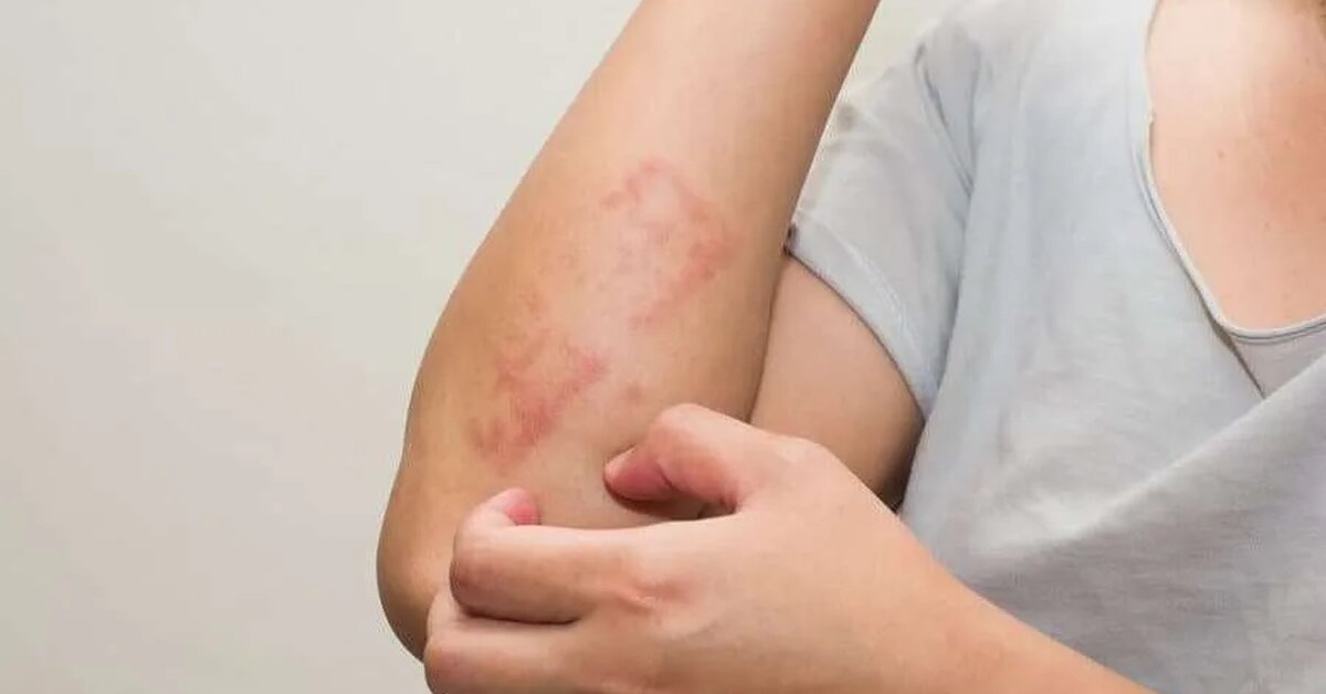 Egzama ve Uçuk Nedir? Neden olur? Belirtileri ve tedavisi