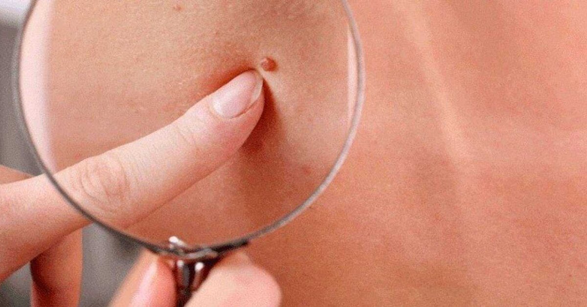 Et Beninden Kurtulmanın Doğal Yolları