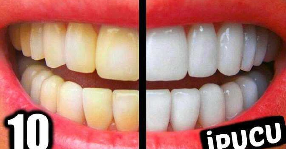 Evde Anında Diş Beyazlatma! 5 Dakikada Bembeyaz Dişlere Sahip Olun!