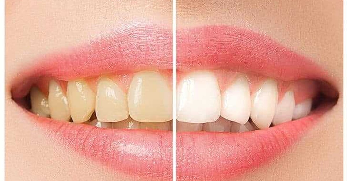 Evde Diş Beyazlatma Yöntemleri