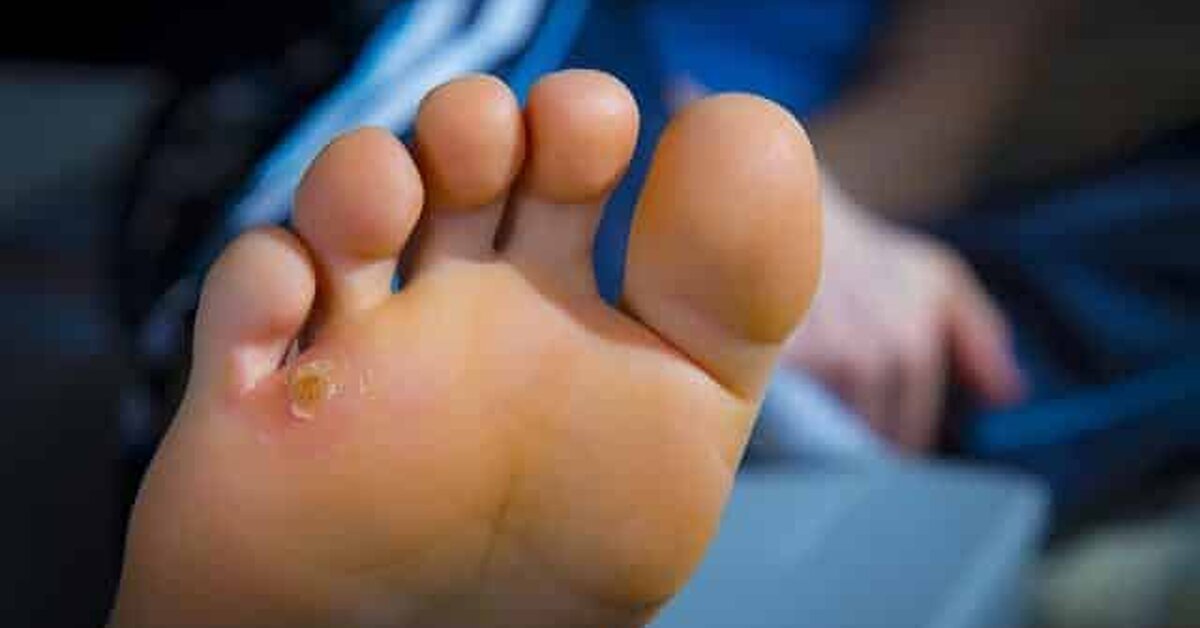 Ayak Nasırını Doğal Yöntemlerle Tedavi Edin!