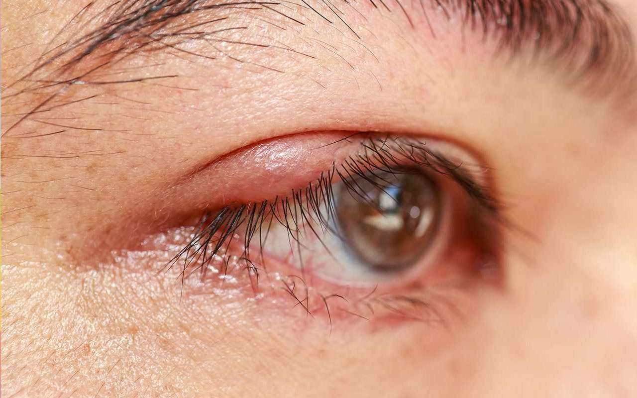 Gözde Arpacık Sorunu İçin Doğal Çözüm!