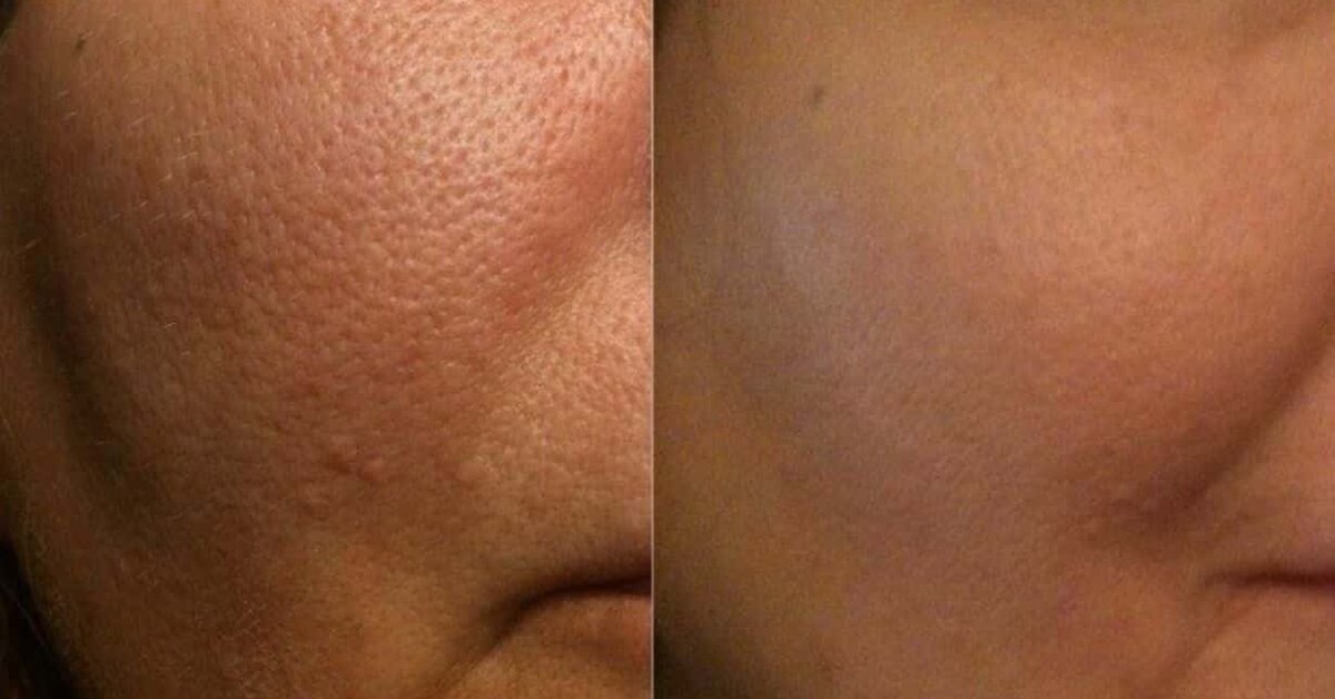 Gözenek Sıkılaştırıcı Maskeler, Nasıl Yapılır