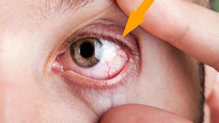Gözünüz çapak mı yapıyor?