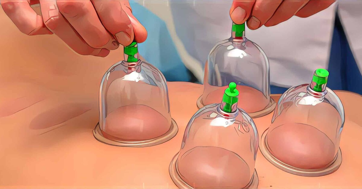 Hacamat Nedir? Hacamatın Faydaları Nelerdir?