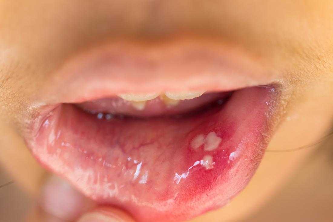 HPV Enfeksiyonu Nedir Belirtileri Nelerdir