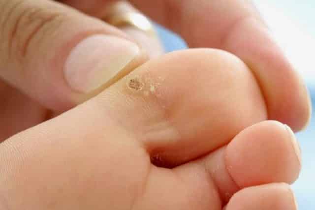 HPV Enfeksiyonu Nedir Belirtileri Nelerdir