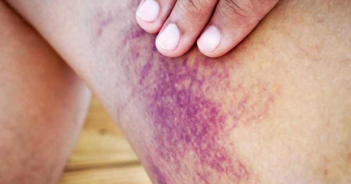 İbrahim Saraçoğlu’ndan Trombosit Düşüklüğü İçin Kür