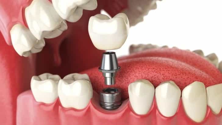 Diş implantı nedir ve nasıl yapılır?