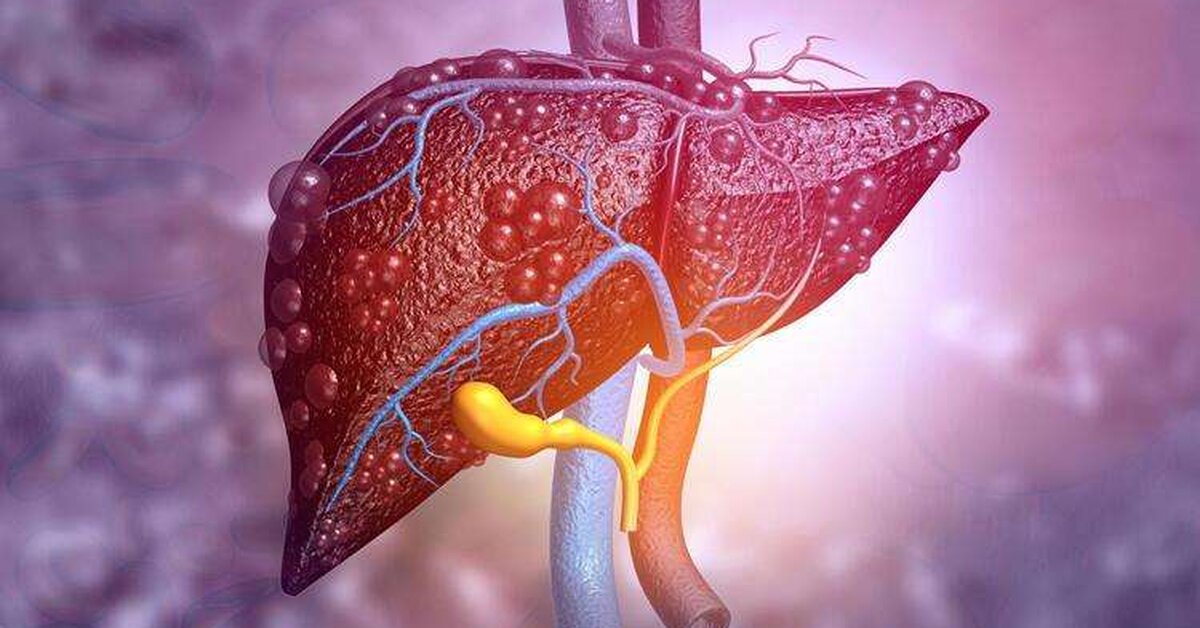 Karaciğer Yağlanmasının Asıl Sebebi ve İyi Gelen Besinler