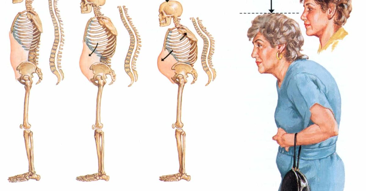 Kemik Erimesine Bitkisel Çözümler Neler?