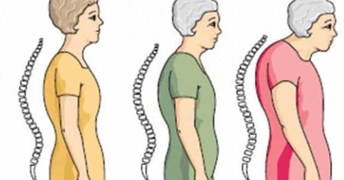 Kemik Erimesini Önleyen Besinler