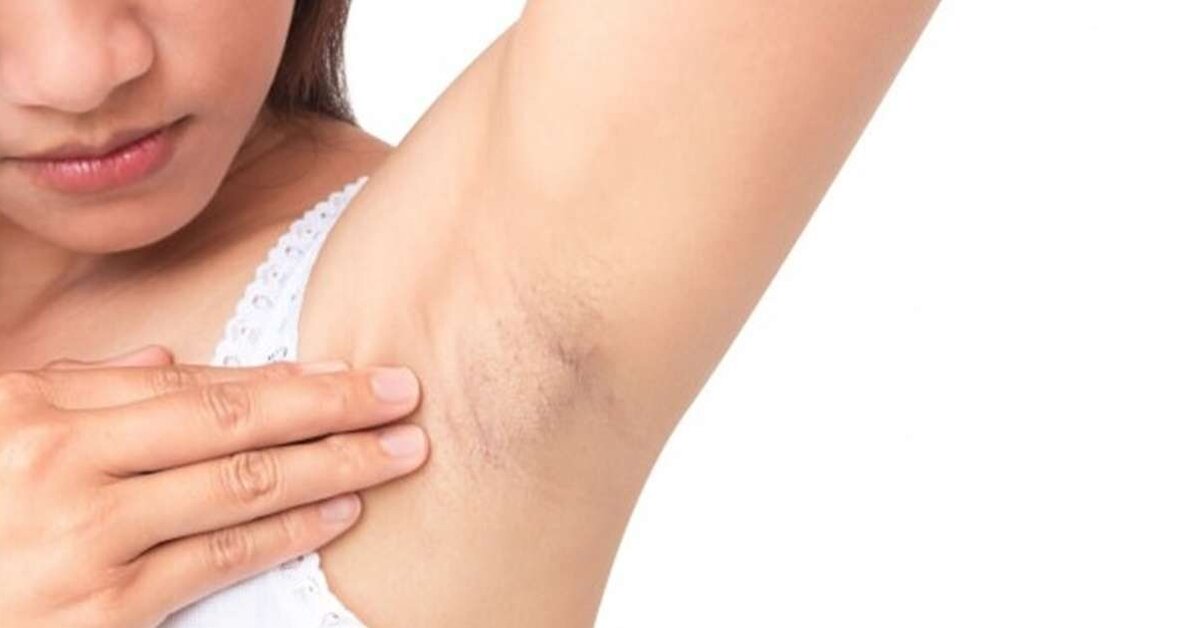 Koltuk Altı Kararmasına Doğal Çözümler